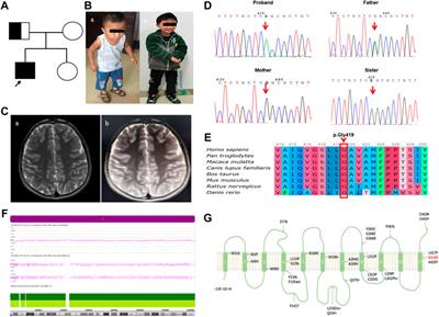 First report of paternal uniparental disomy of chromosome 8 with SLC52A2 mutation in Brown-vialetto-van laere syndrome type 2 and an analysis of genotype-phenotype correlations